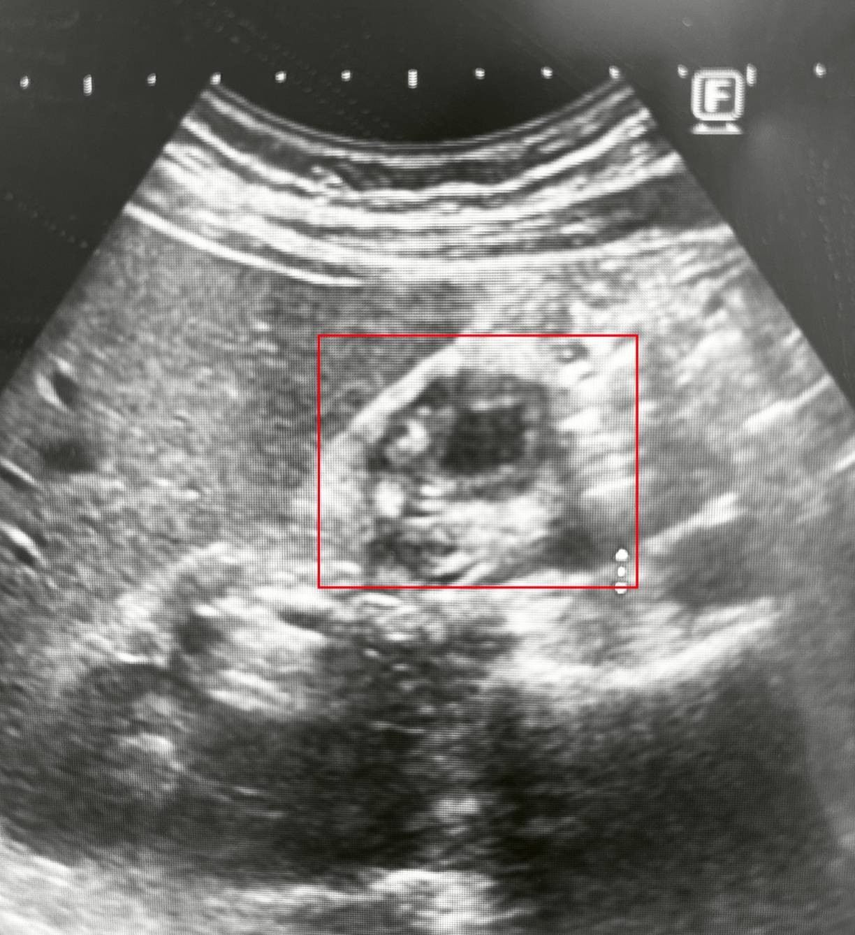 博田國際醫院肝膽胰李金德教授妙手回春 罹「膽囊腺肌症 」症男子恢復健康